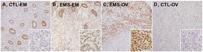 Association Between Impairment of DNA Double Strand Break Repair and Decreased Ovarian Reserve in Patients With Endometriosis